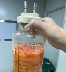 偃师水动力吸脂手术要做多久？